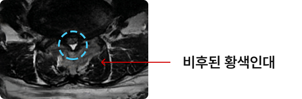 비후된 황색인대