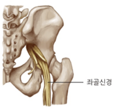 좌골신경통 이미지