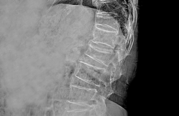 X-RAY 이미지