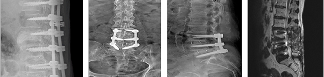 나사못고정수술후 x-ray 와 MRI 사진들